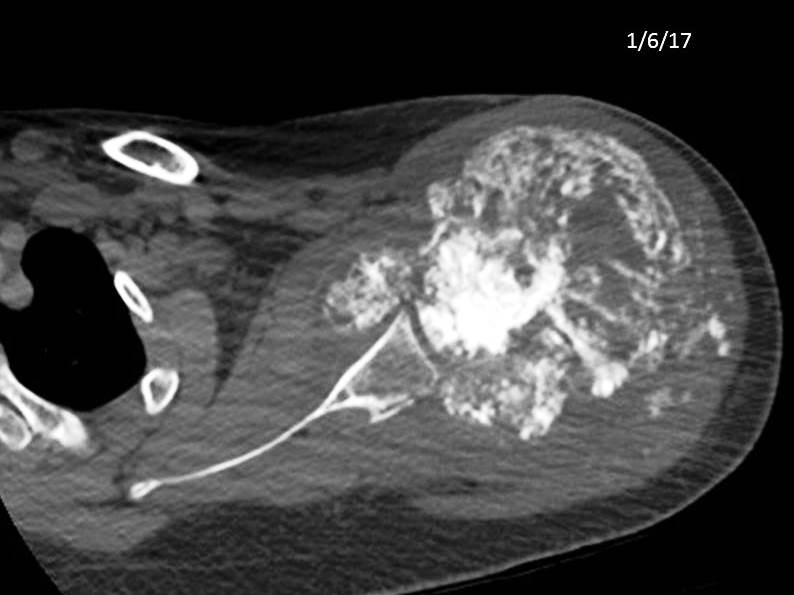 Figure 4 for case Osteosarcoma ( RID4010 ) with a pathologic fracture